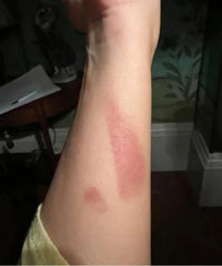 Problematic Skin Concerns Before After