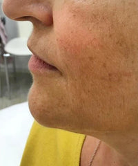 Problematic Skin Concerns Before After