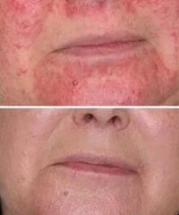 Problematic Skin Concerns Before After