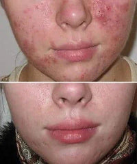Problematic Skin Concerns Before After