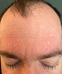 Problematic Skin Concerns Before After