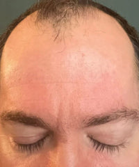 Problematic Skin Concerns Before After