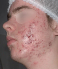 Problematic Skin Concerns Before After