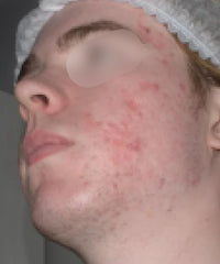 Problematic Skin Concerns Before After