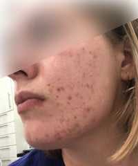 Problematic Skin Concerns Before After