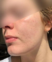 Problematic Skin Concerns Before After