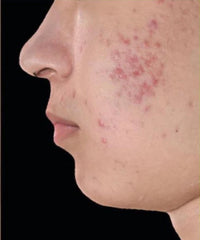 Problematic Skin Concerns Before After